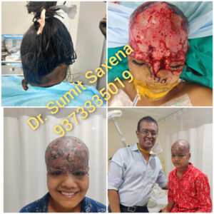 Scalp Avulsion Injury Reconstruction
